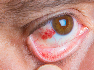 结节性表层巩膜炎眼睛表面长血色结节图