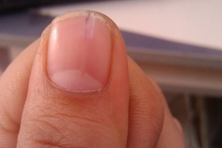 甲纵裂指甲裂开一个口图