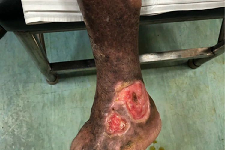 静脉曲张性溃疡脚踝溃疡图