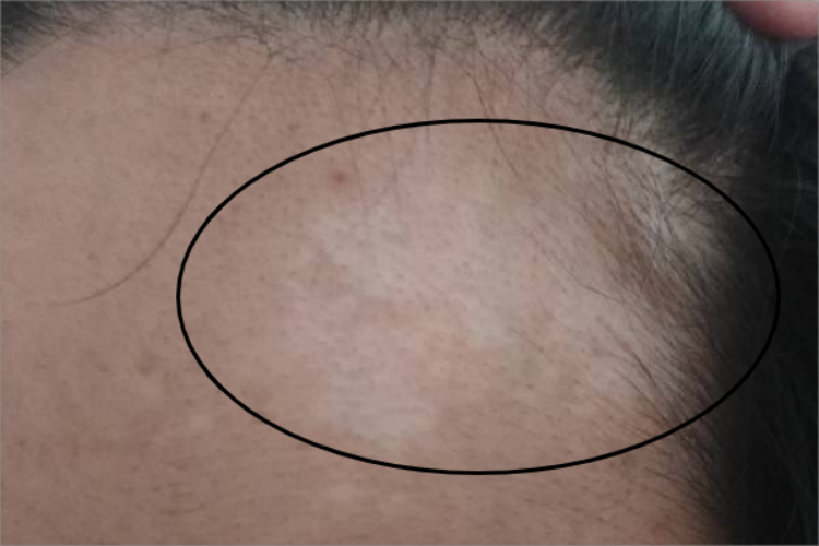 无色素痣前额白斑图 无色素痣前额白斑图