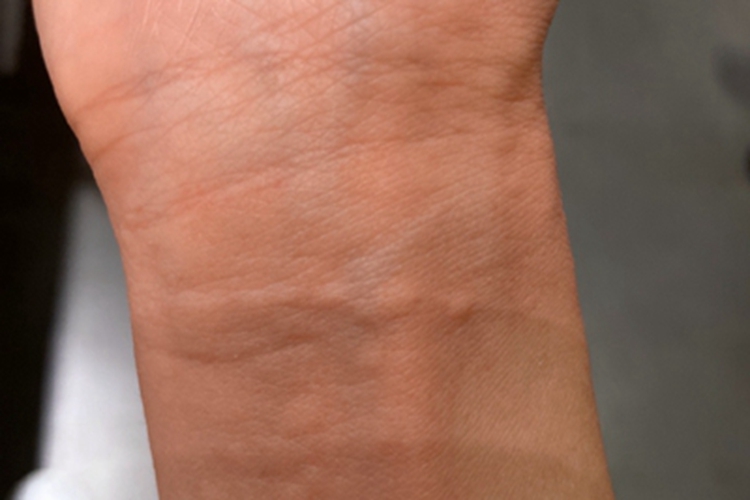 海鲜过敏手腕上有疙瘩图