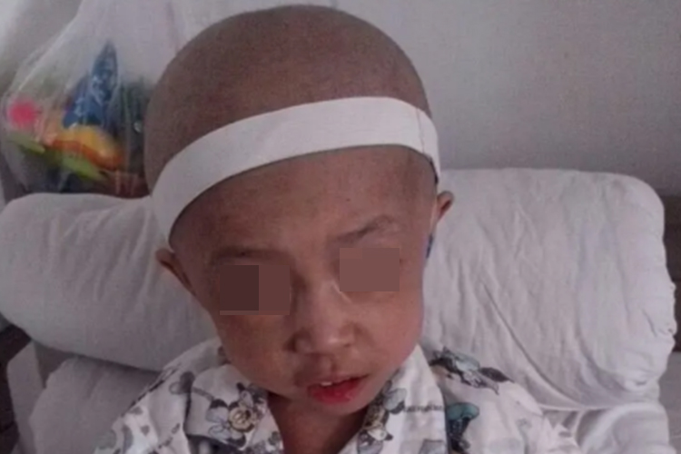 地中海贫血儿童面容图