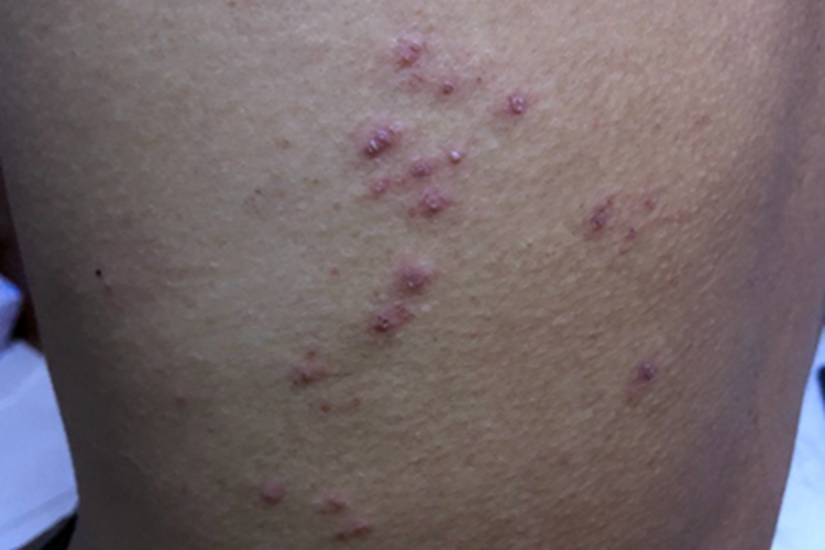 成人痒疹背部结痂图 成人痒疹背部结痂图