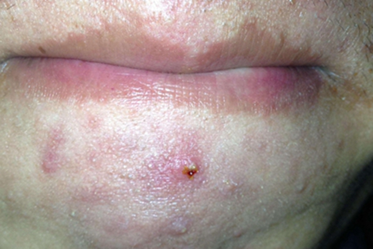 马拉色菌毛囊炎下巴丘疹图片