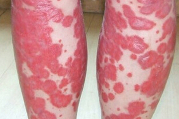 红皮病初期图 红皮病初期图