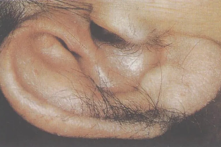 外耳道多毛症图