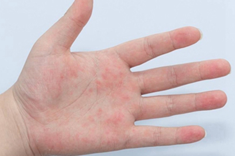镍皮炎左手掌有小红点图 镍皮炎左手掌有小红点图