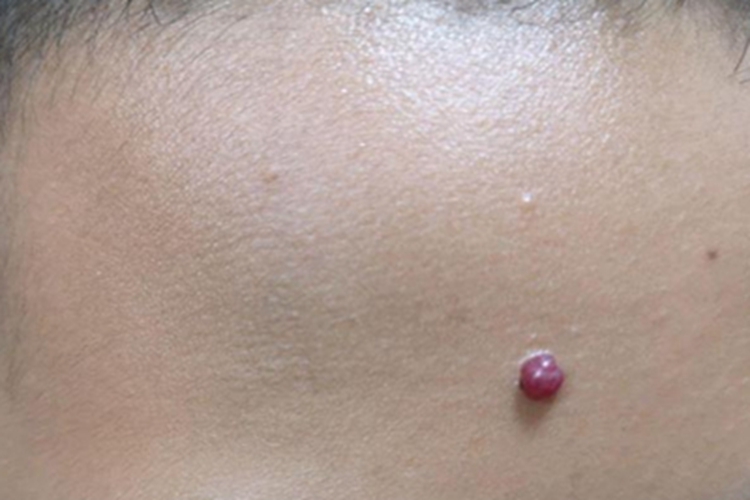 樱桃状血管瘤肉球图