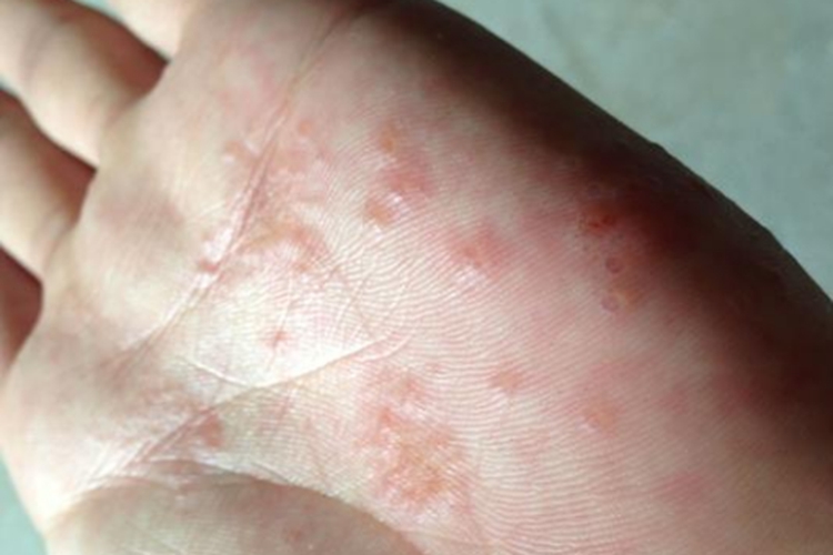 小孩水疱型手癣图