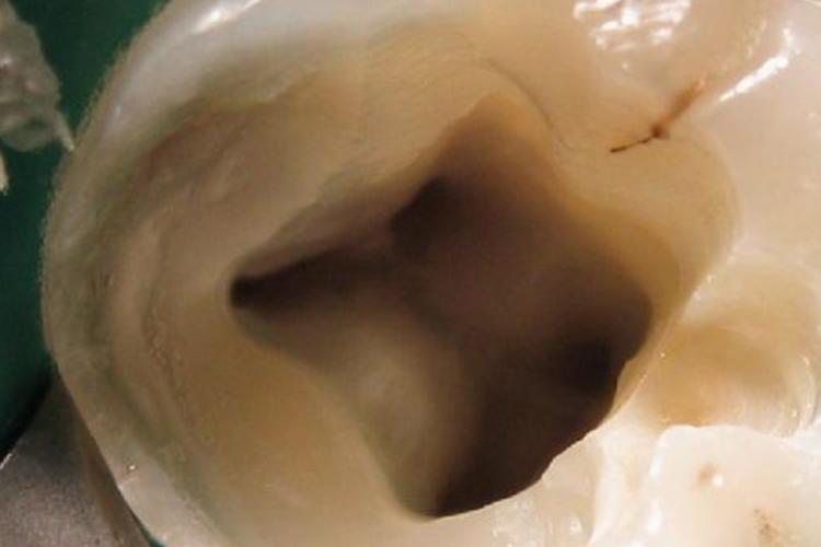 下颌磨牙开髓洞形图