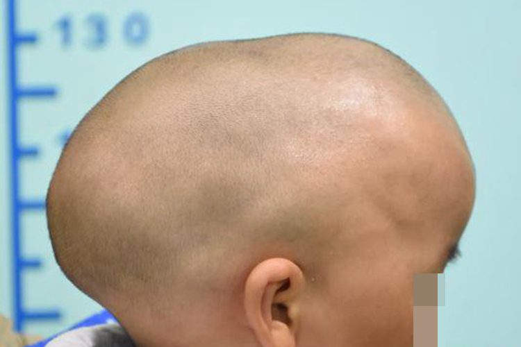 狭颅症舟状头畸形图