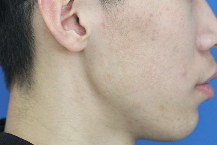 龅牙齿双颌突出图 龅牙齿双颌突出图