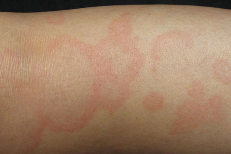 离心性环状红斑图