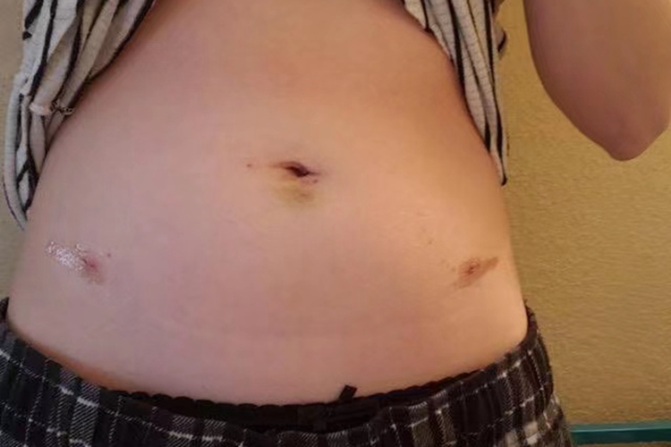 经腹腔镜输卵管结扎疤痕图 经腹腔镜输卵管结扎疤痕图