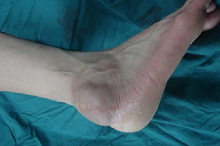 踝关节骨膜炎疼痛部位图