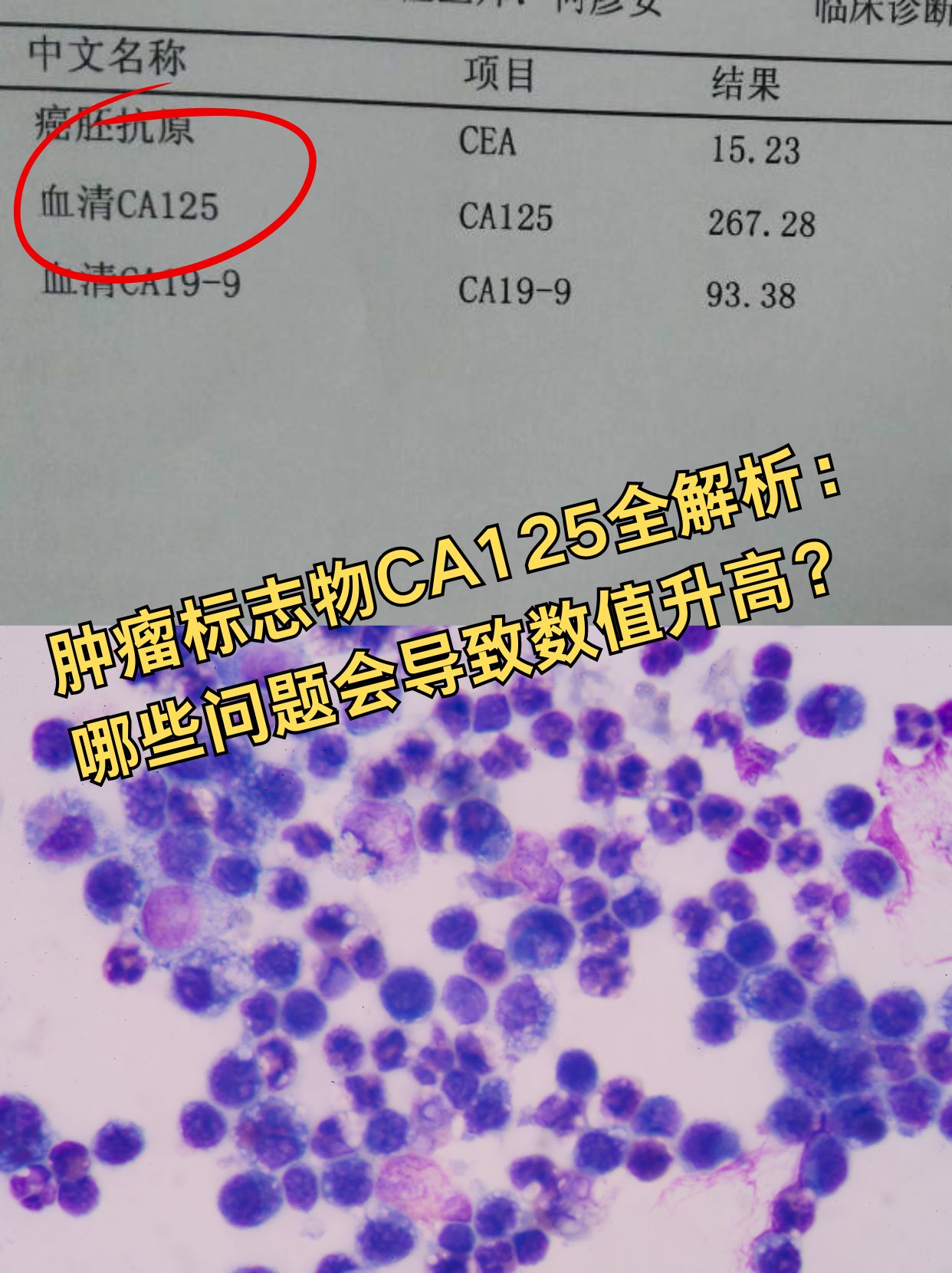 CA125是什么肿瘤指标，一文告诉你！