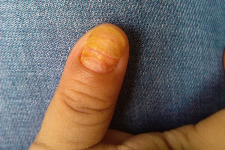 小孩远端侧位甲下型灰指甲图 小孩远端侧位甲下型灰指甲图