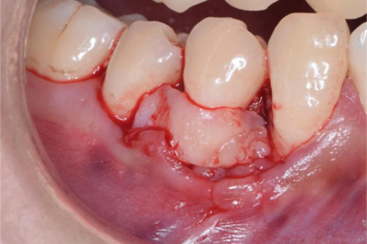 切口深达骨面图 切口深达骨面图