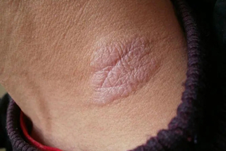 局限性神经性皮炎颈部有红斑片图