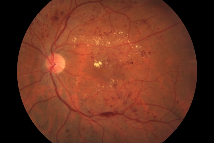 非增生性糖尿病视网膜病变图