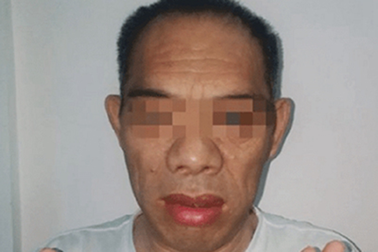 肥大性骨关节病鼻部症状图 肥大性骨关节病鼻部症状图