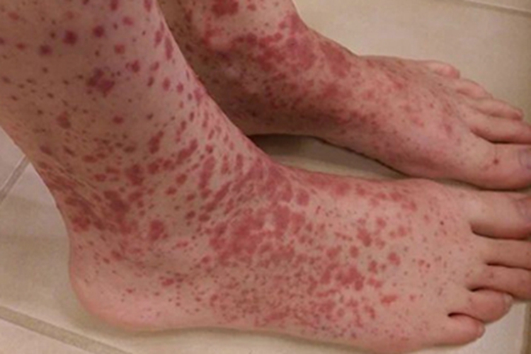 暴发性紫癜脚部斑图