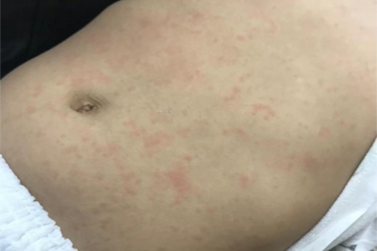 幼儿急疹肚子上起小红斑图