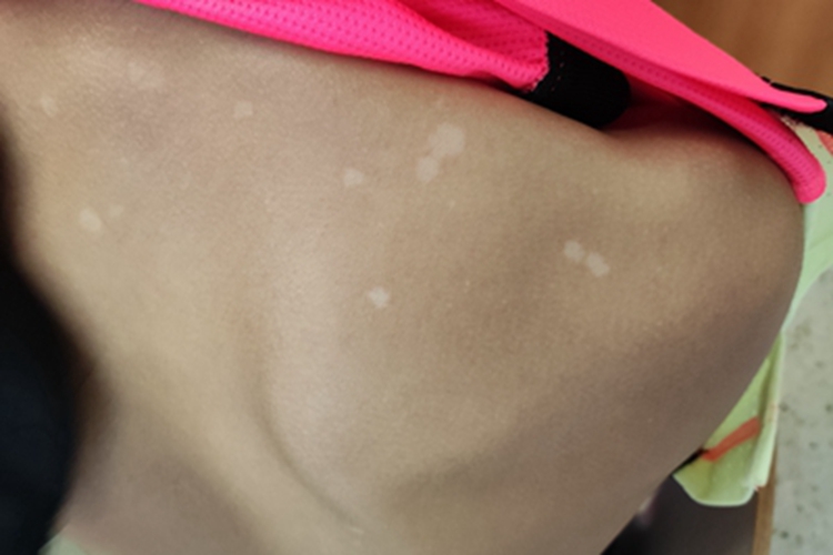 花斑癣背部有几片小白斑图