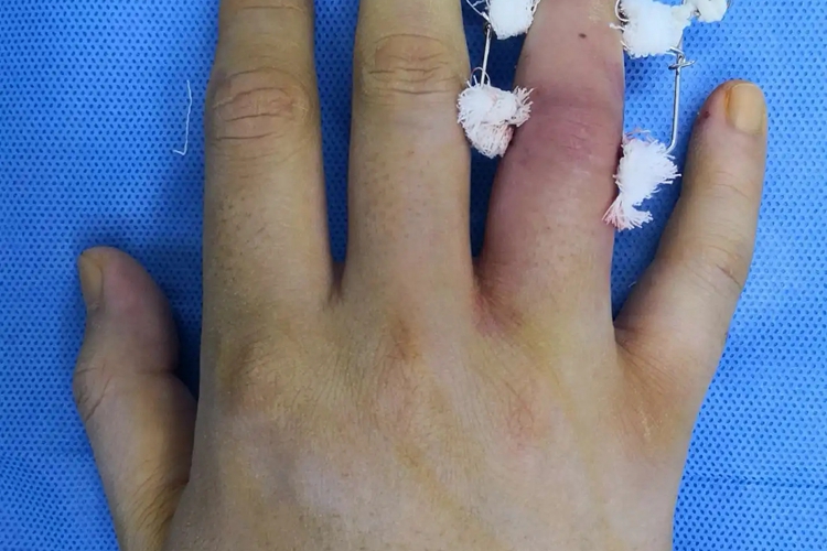 骨折手指皮肤肿胀图 骨折手指皮肤肿胀图