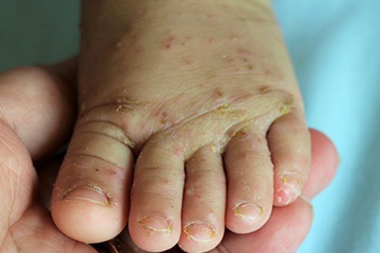 疥疮脚背结痂图