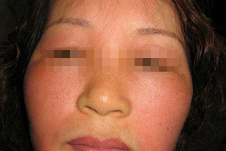 职业性光毒性接触性皮炎红斑图