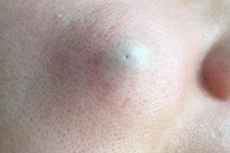 脸上表皮样囊肿图