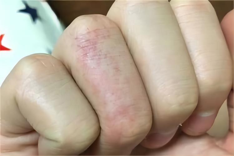手部血小板减少性紫癜图
