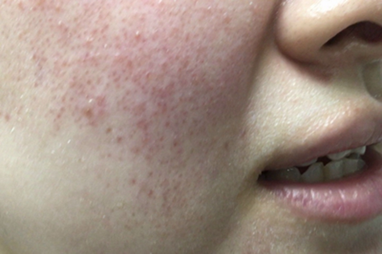 红斑毛细血管扩张型酒糟鼻丘疹图 红斑毛细血管扩张型酒糟鼻丘疹图