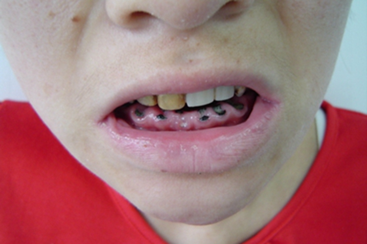 干燥综合征牙齿脱落缺损图