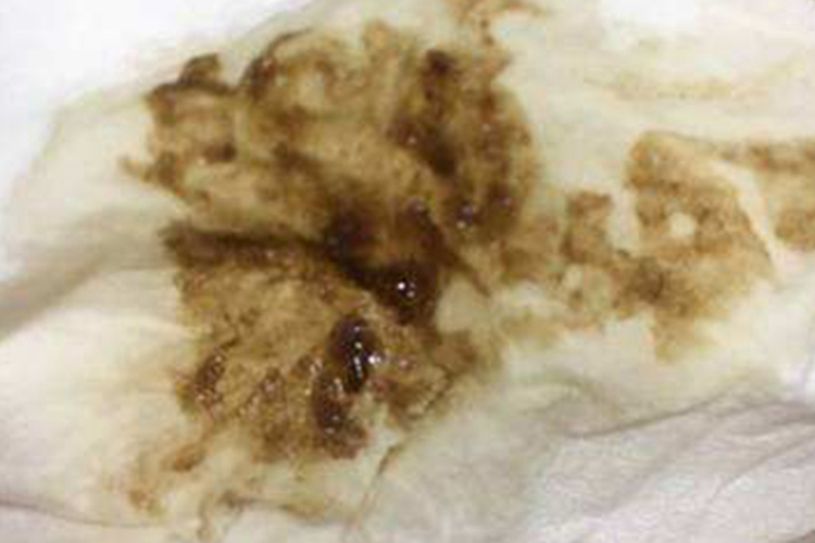 阴道排出褐色豆腐渣样分泌物图 阴道排出褐色豆腐渣样分泌物图