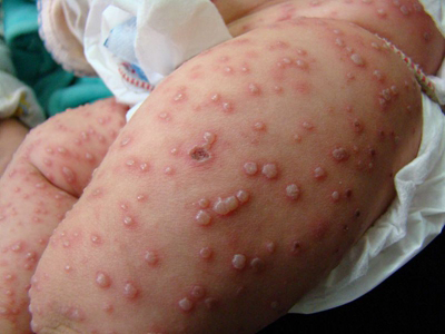 出水痘的症状早期图片