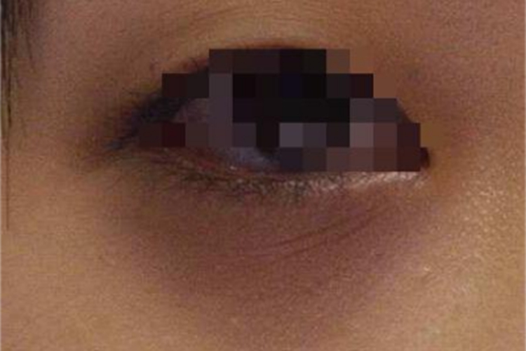 眶周黑变下眼睑青灰色图