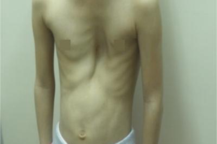 脊椎骨骺发育不良腹部症状图 脊椎骨骺发育不良腹部症状图