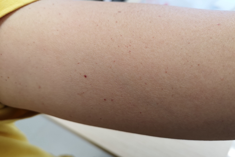 樱桃状血管瘤胳膊疙瘩图