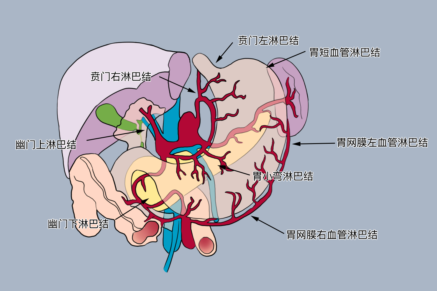 胃癌局部淋巴结转移示意图