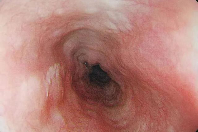 食道鳞状细胞癌图