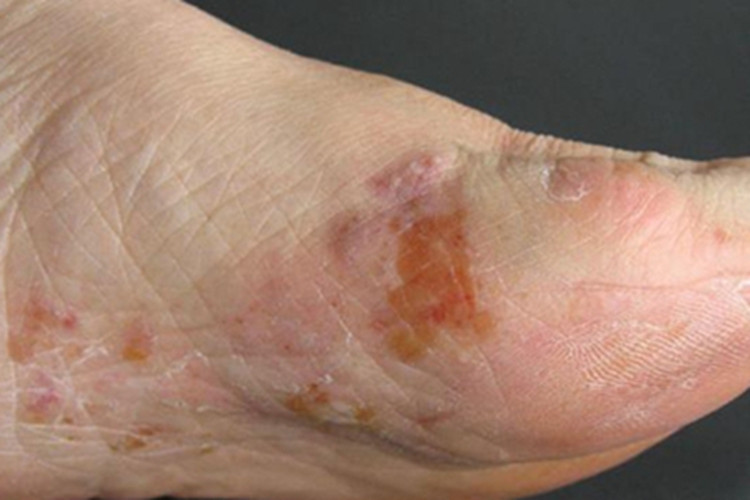 艾滋病感染性皮肤损害脚底症状图
