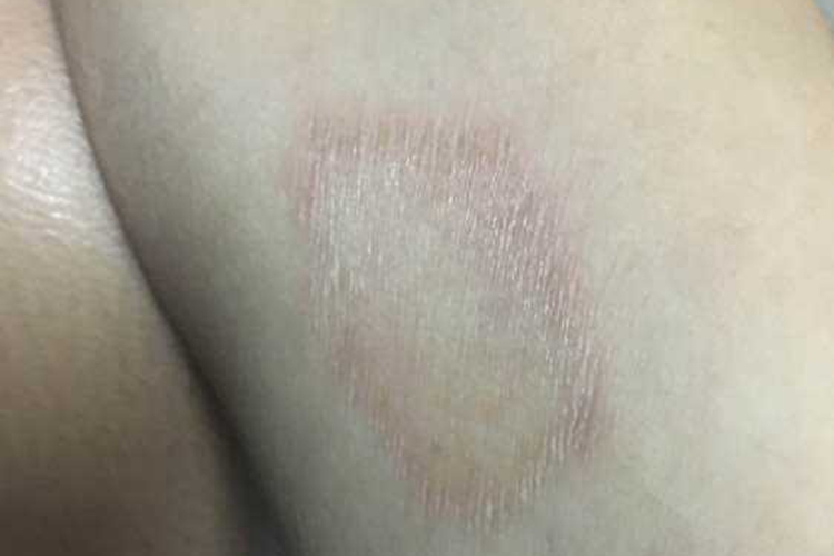 体癣恢复色素沉着图