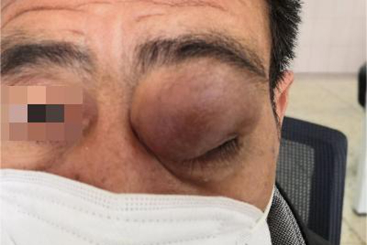 眼眶神经鞘瘤眼部症状图