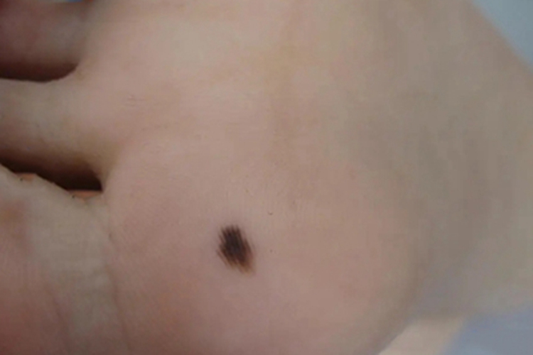 交界痣脚底有块褐色痣图