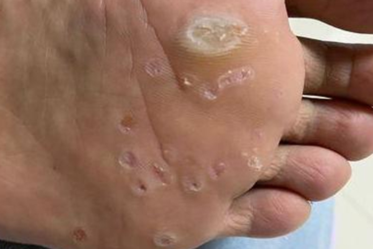 跖疣恢复状态图