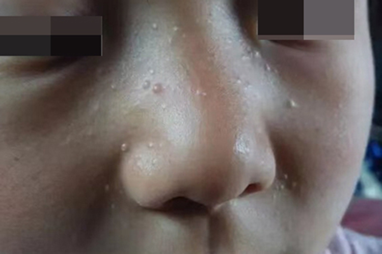 原发性粟丘疹面部症状图