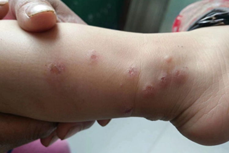 虫咬皮炎小腿结痂图