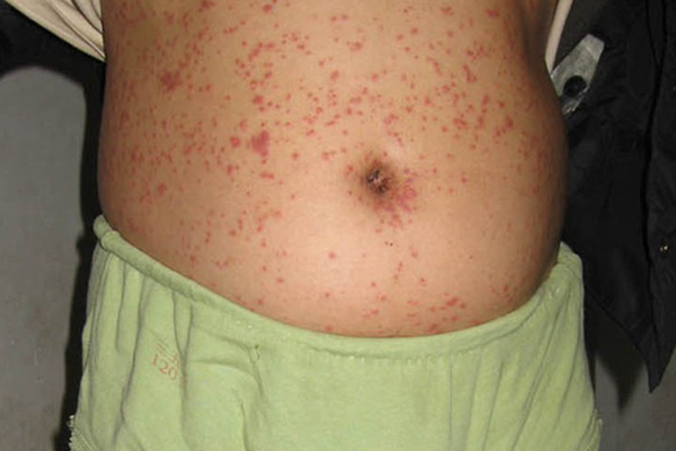 接触性皮炎红丘疹图